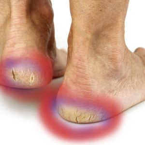 Sever's Disease Heel Pads | FootStore.au